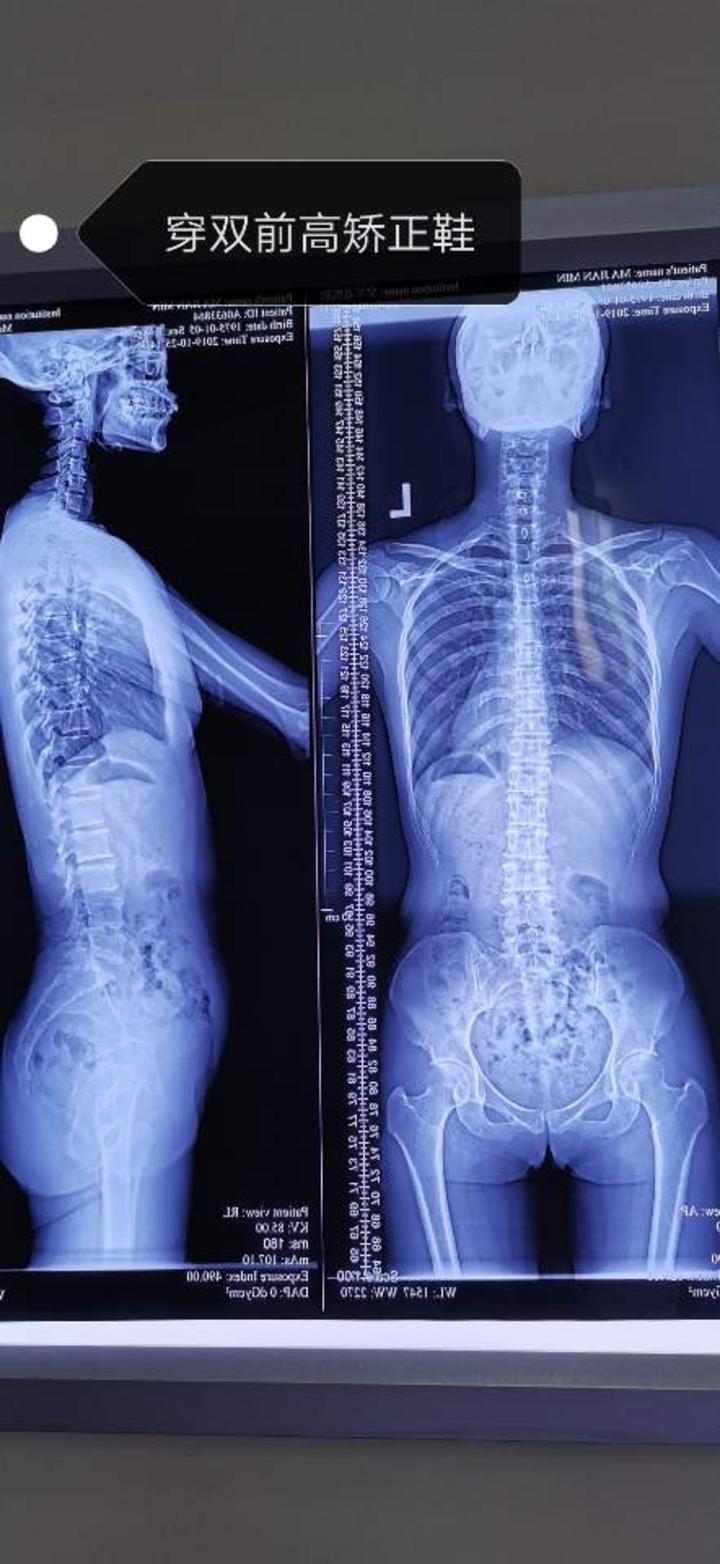 正常人的脊柱从后面观察,呈一条直线并且左右对称,侧面看有四个正常的