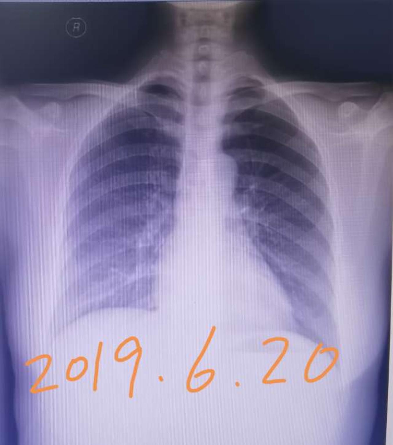刘懿博士说肺癌二九三八胸片能不能用来复查肺部磨玻璃结节