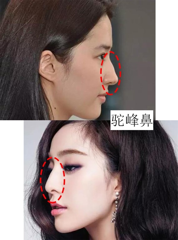 驼峰鼻的几种矫正方法