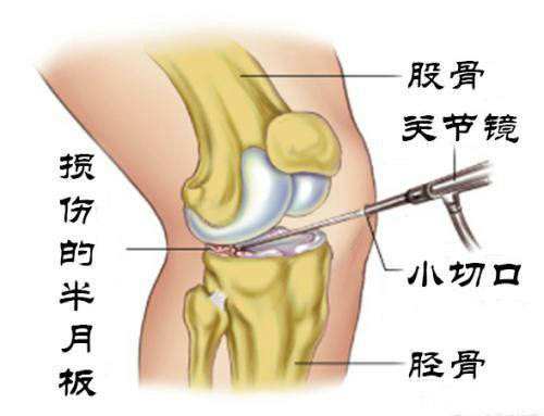 半月板磨损怎么治疗