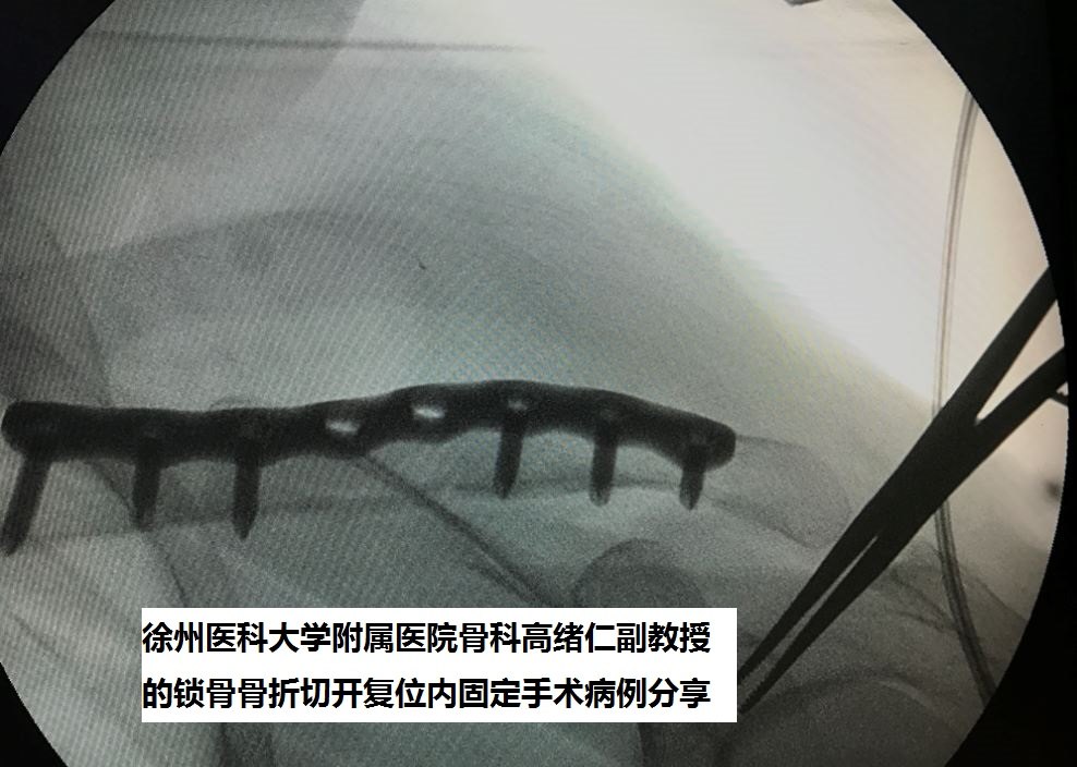 徐州二院骨科高绪仁如何切开复位钢板内固定治疗锁骨骨折