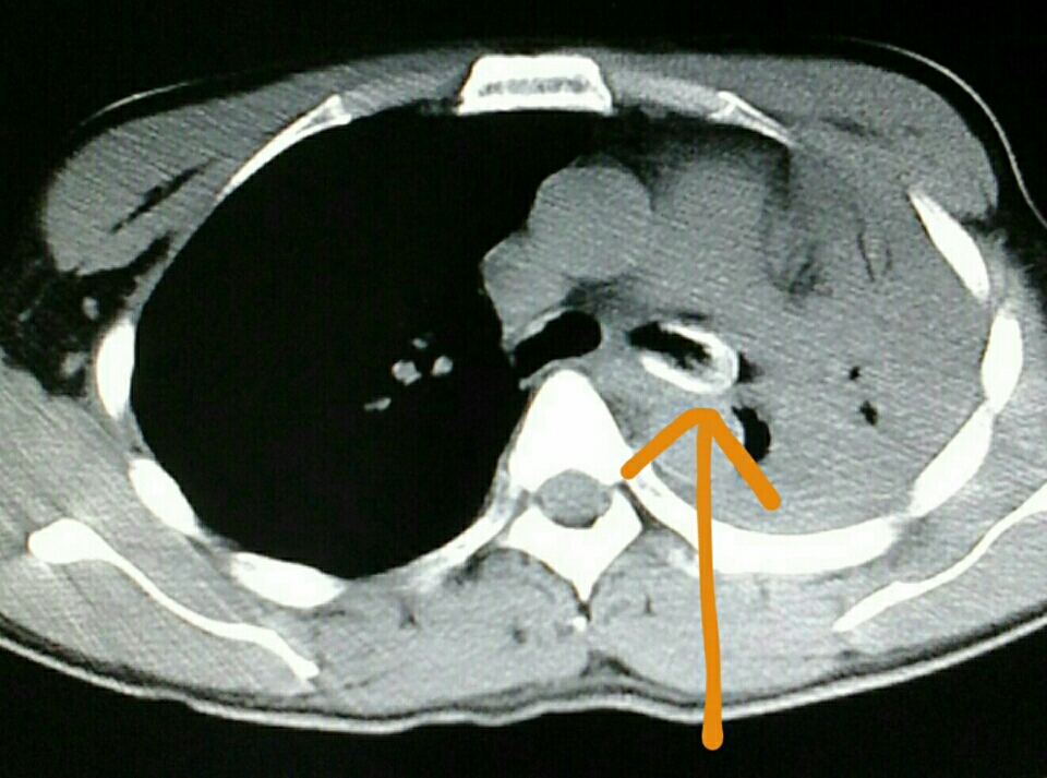 先看影像学检查:胸片,ct,看到了左主支气管内异物以及阻塞性肺不张.
