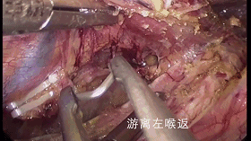 食管癌术中游离左喉返神经手术视频