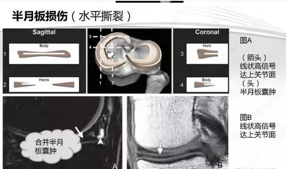 半月板半月板损伤的mri诊断