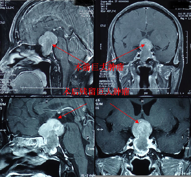 手术前后增强磁共振,显示肿瘤全切除)下面是一位生长激素型垂体瘤病人