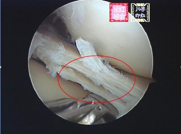 半月板损伤