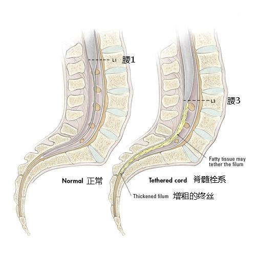 脊髓栓系综合征的概述及其临床表现