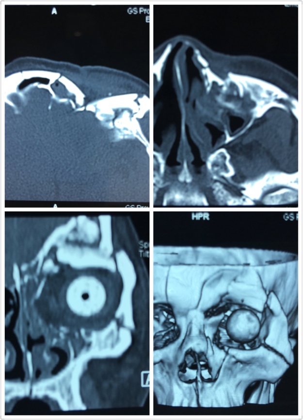【病例分享】眼眶多发骨折伴眼球破裂