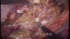 食管癌术中游离左喉返神经手术视频