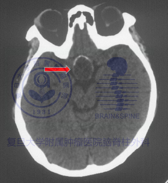 颅咽管瘤