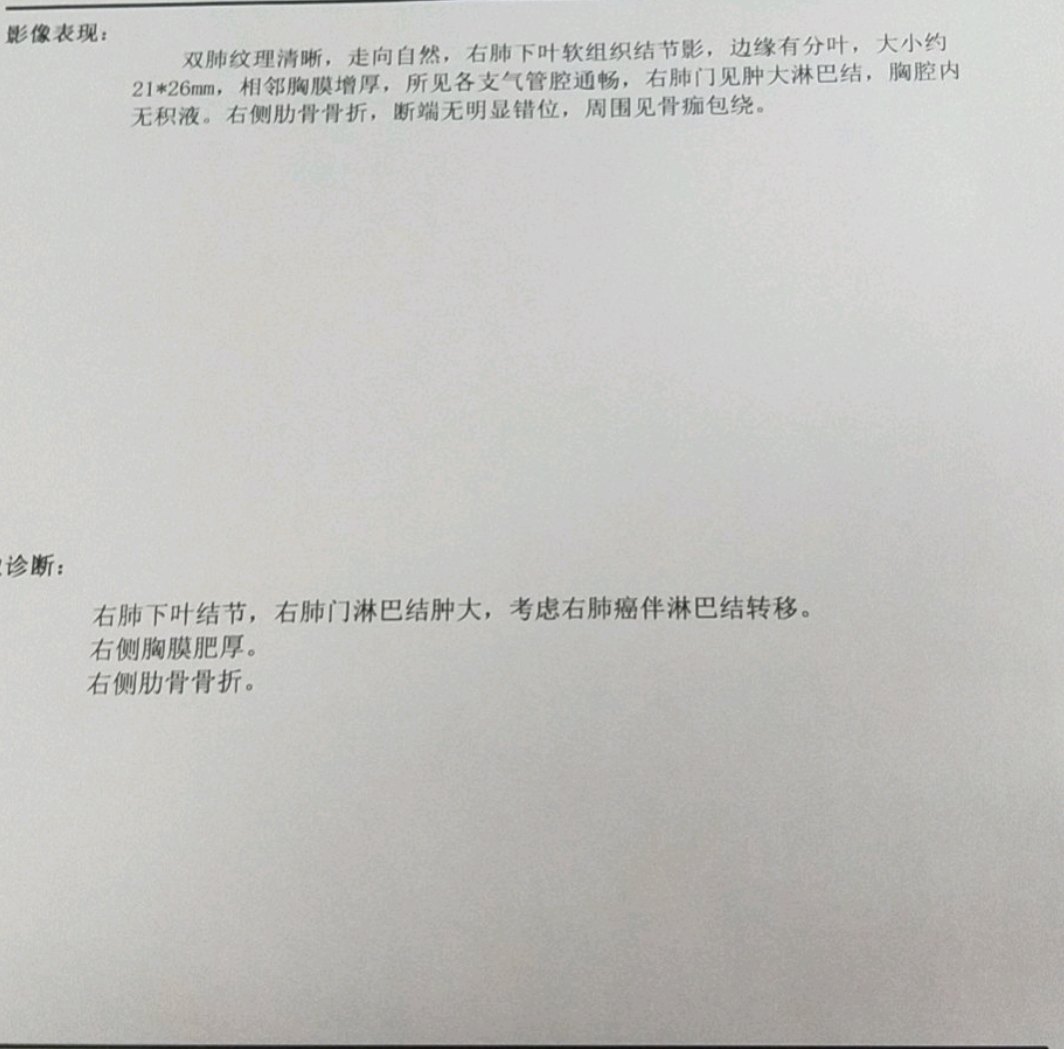 刘懿博士说肺癌一〇七一肺结节当地医院为何说做不了手