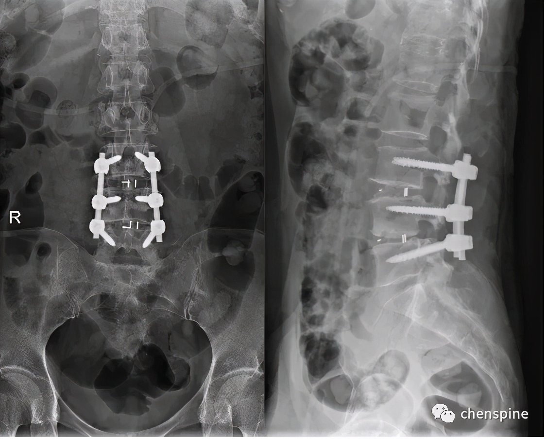 腰椎x线片: 腰椎术后,l3/4-l4/5行腰椎减压植骨融合内固定术09术后有
