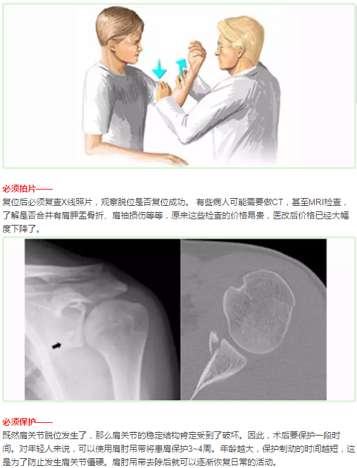 肩膀为什么会经常脱臼