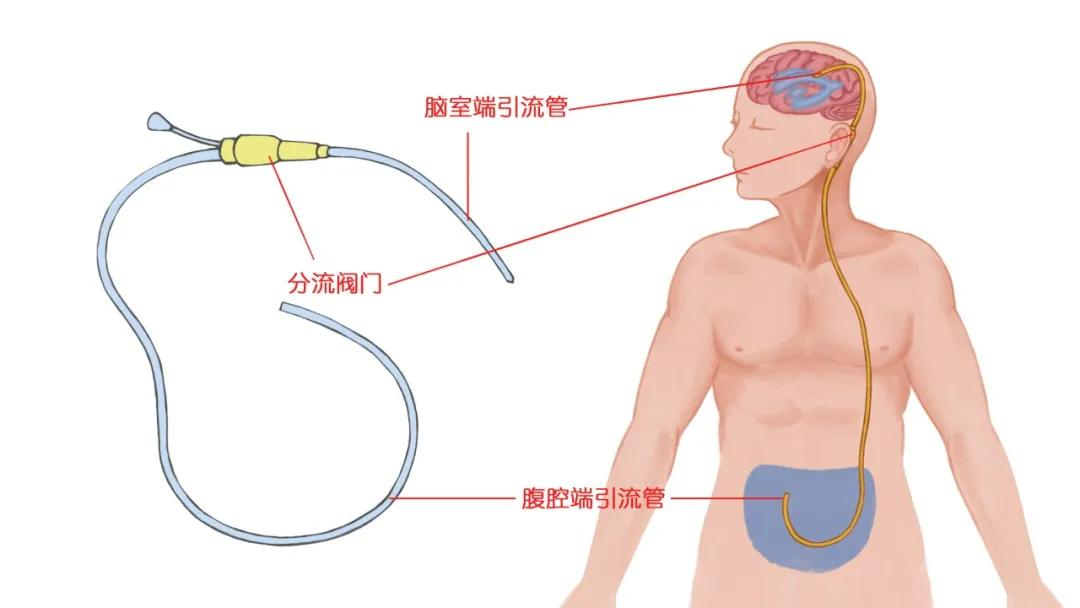 脑积水分流手术术后管子还需要更换吗