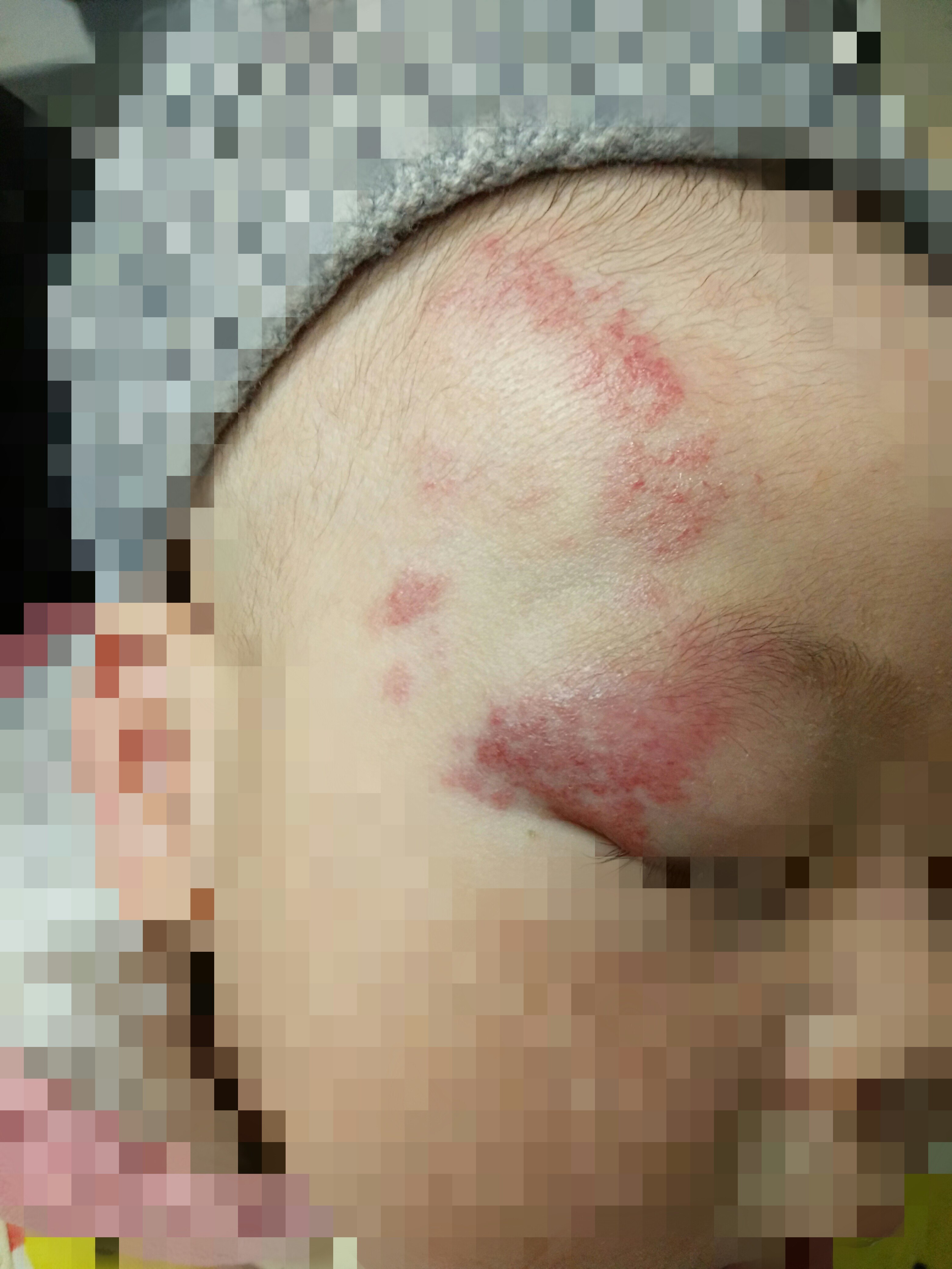 婴幼儿及儿童眼睑血管瘤常用的治疗办法