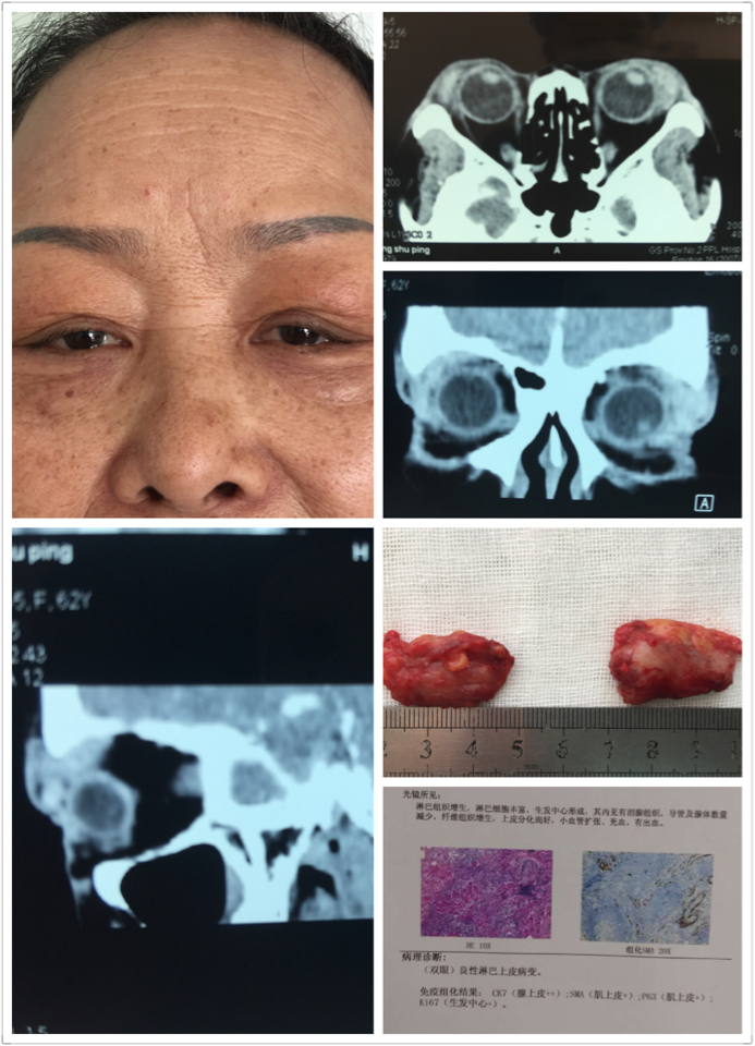 例一:女性,64岁,因双眼睑肿胀半年来诊.影像诊断考虑泪腺混合瘤.