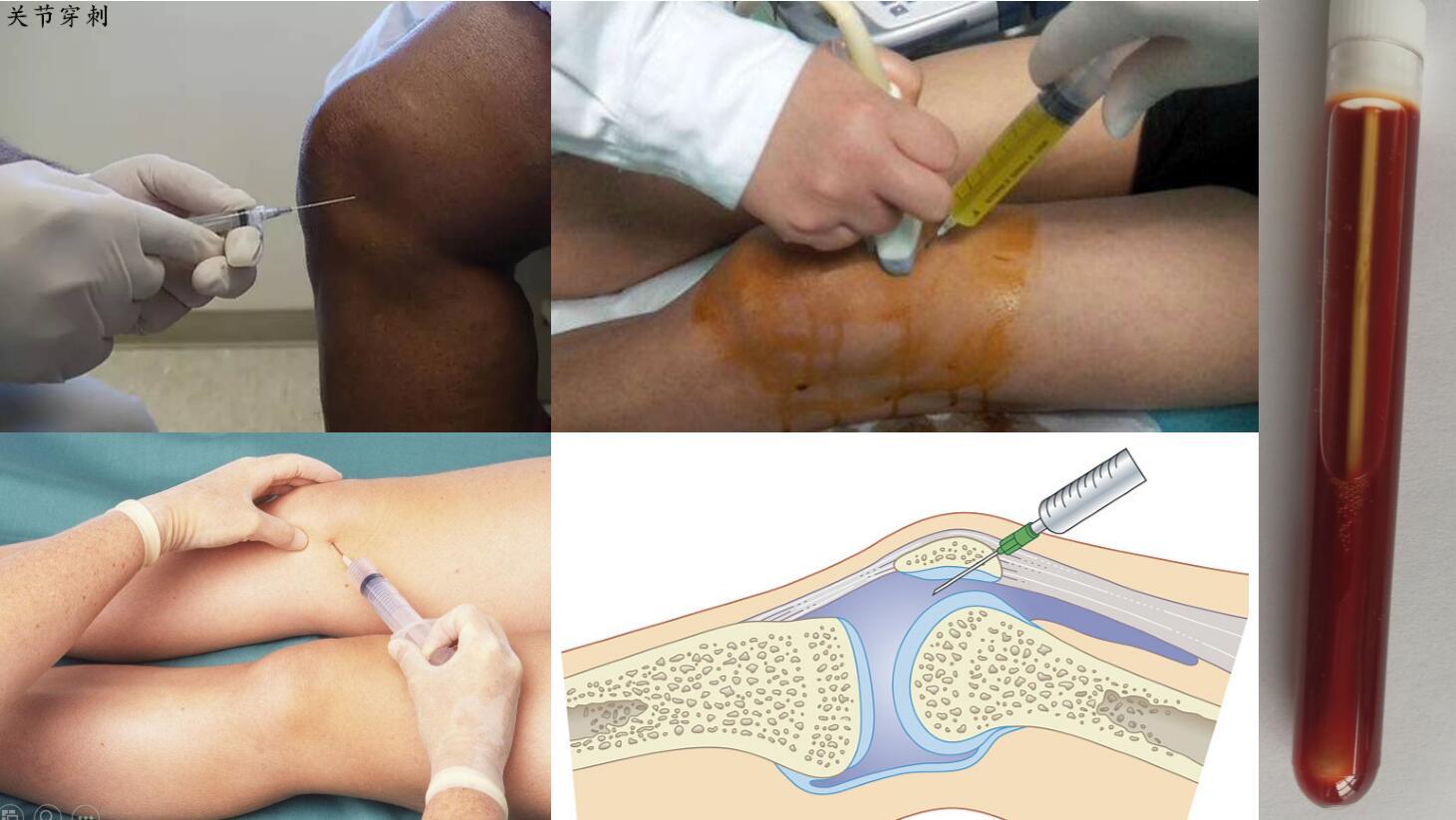 图10膝关节积液穿刺抽液(3)关节腔注射疗法包括封闭针,玻璃酸钠注射液