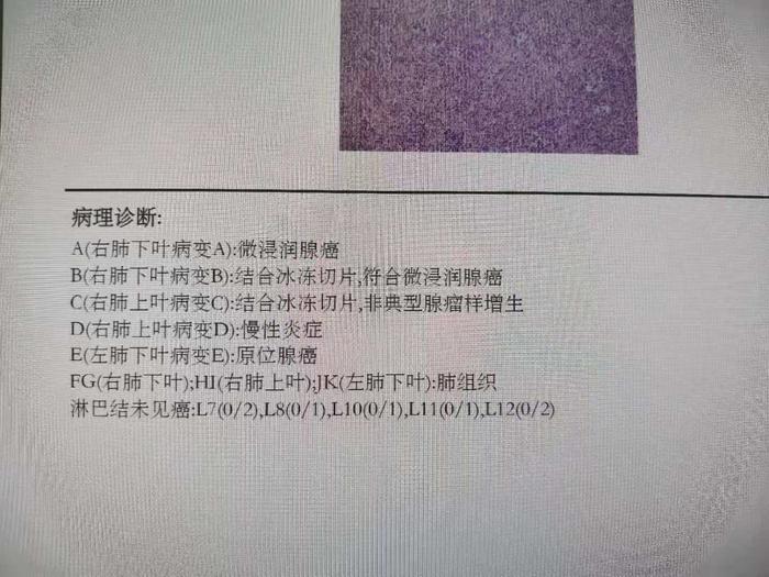 图3f病例4:女性,68岁,发现肺肿物一个月,ct示左肺上叶肿物4枚(图4a-c)