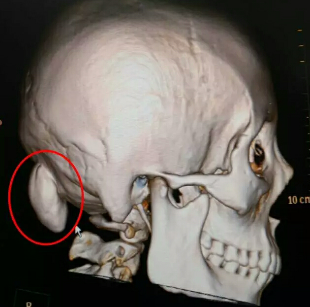 切除一个鸡蛋大的头部骨瘤