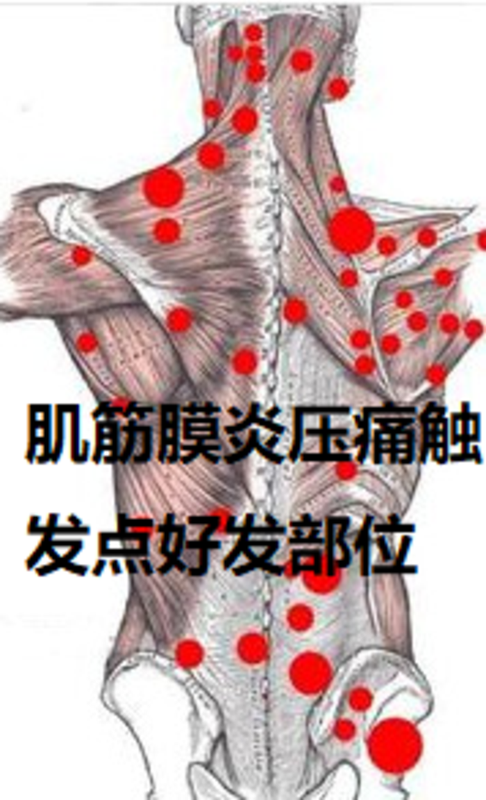 累积性劳损性肌筋膜炎,表现为颈源性头痛,眩晕,颈肩部,腰臀部,膝关节