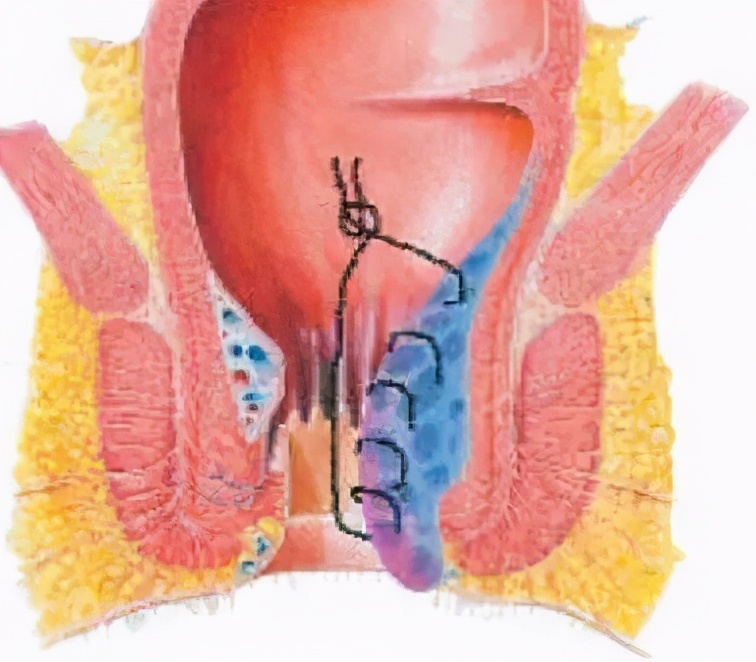 原创当天可出院的痔疮手术怎么做