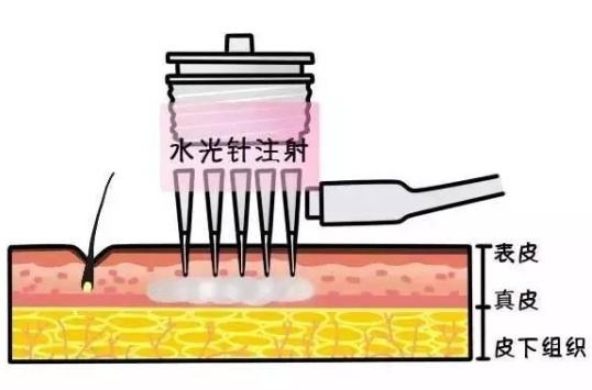 doctorlu水光针的治疗原理中胚层疗法