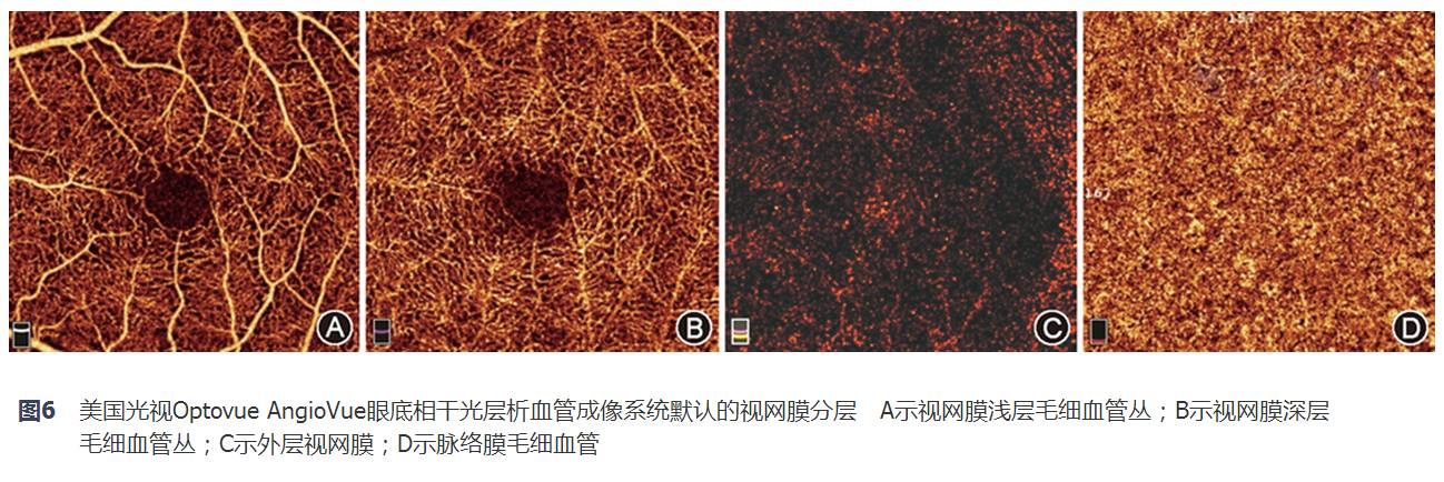 相干光层析血管成像系统默认的视网膜分层 a示视网膜浅层毛细血管丛;b