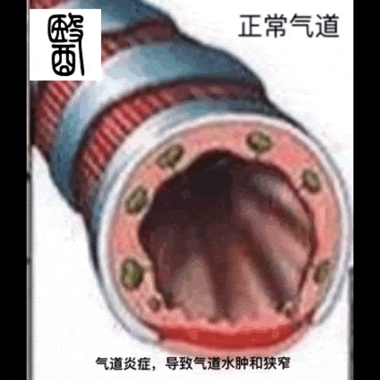 哮喘病都是过敏性哮喘么