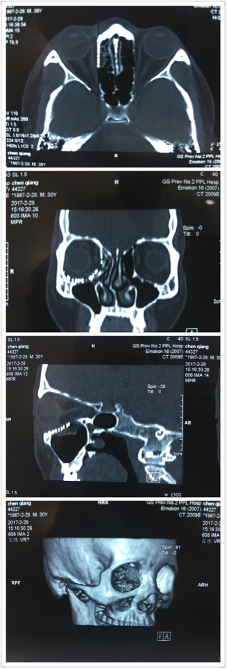 眼眶骨折整复术