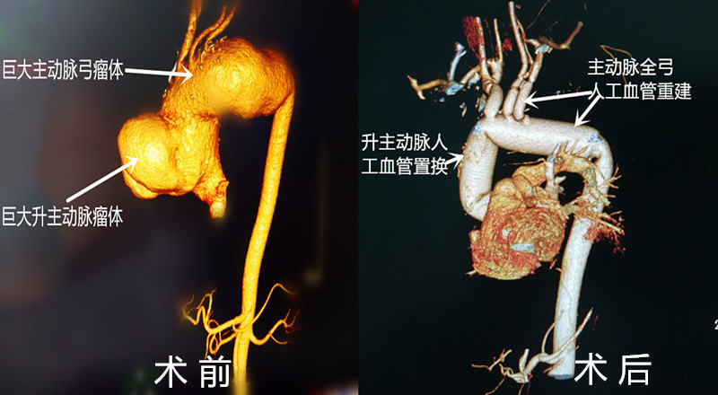 病例3:主动脉弓动脉瘤hybrid手术患者为61岁男性,因胸部疼痛至当地