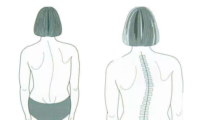 重度脊椎侧弯不做手术会出现什么后果