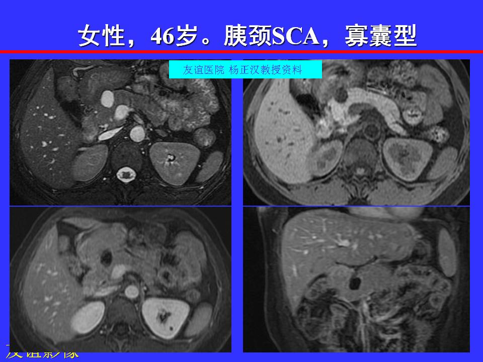 胰腺导管内乳头状黏液性肿瘤的磁共振表现