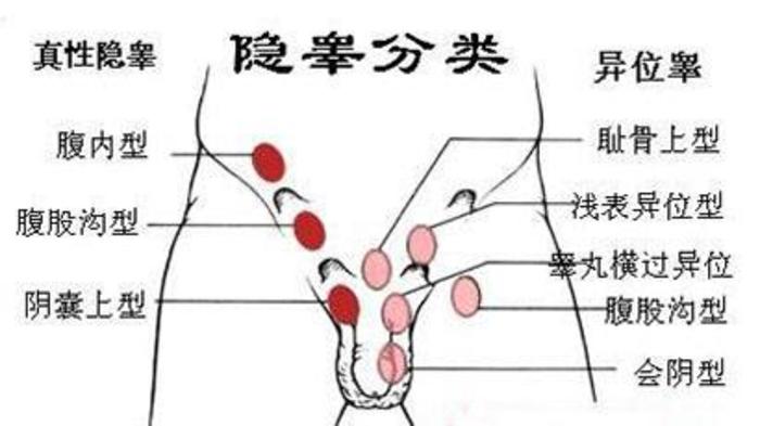 张明亮医生称:男人只有一个睾丸,通常以隐睾症患者居多!