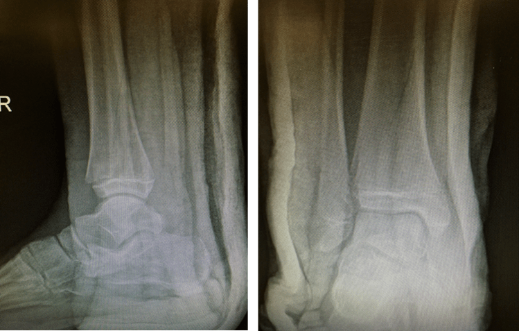 以上为踝关节稳定骨折,可行石膏保守治疗以上为踝关节不稳定骨折,需