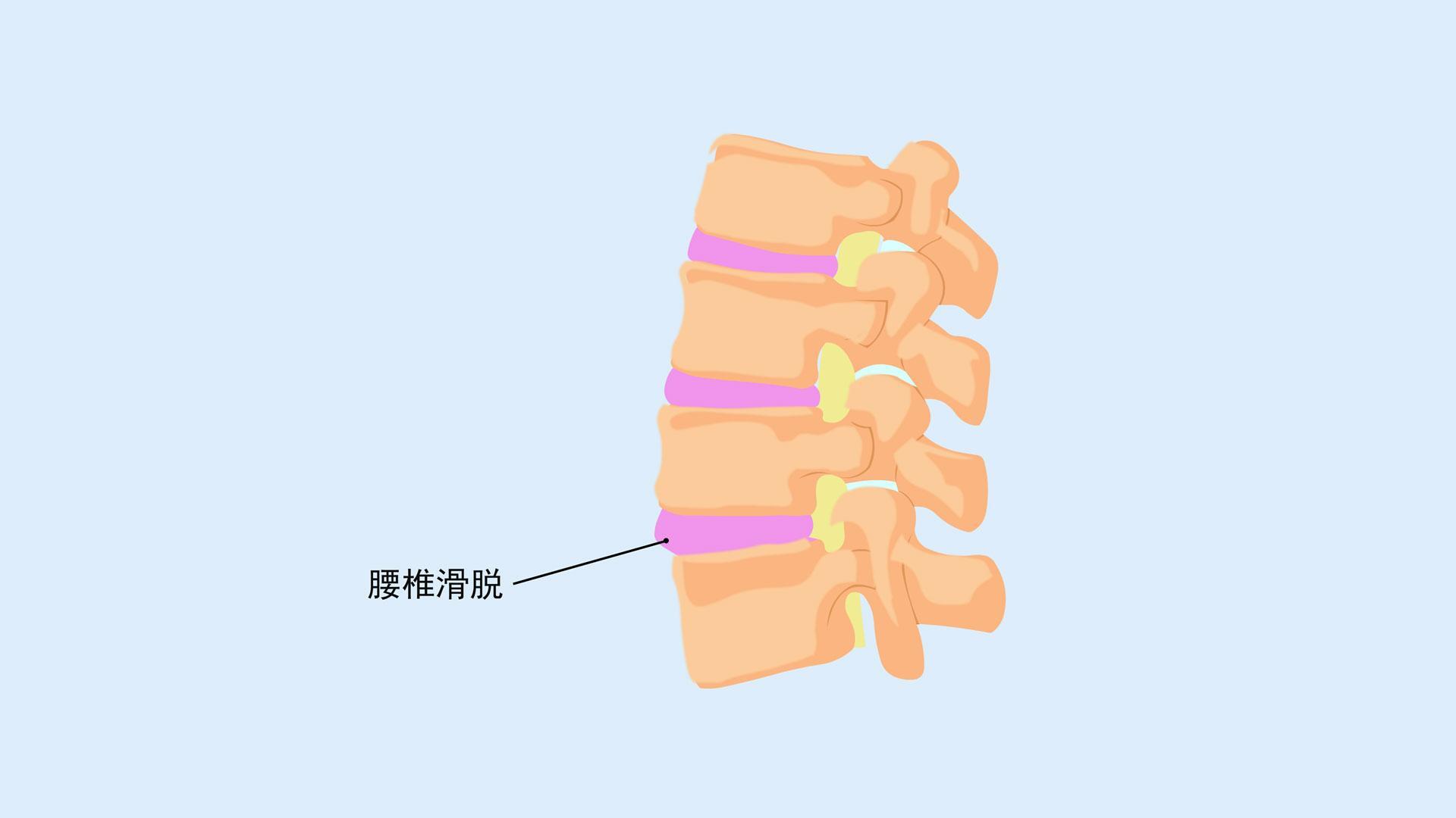 腰椎滑脱三度怎么治疗