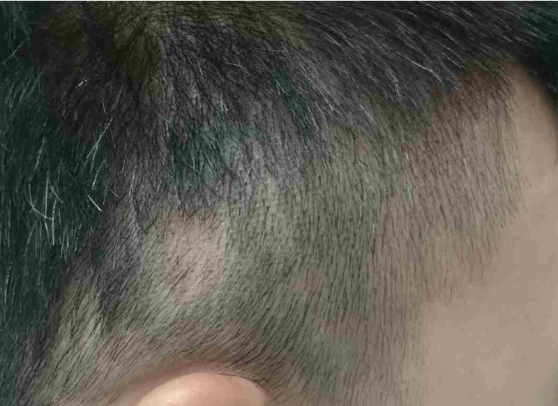 脱发有很多种,这位患者的情况,医学上叫做"虫蚀样脱发",请大家仔细