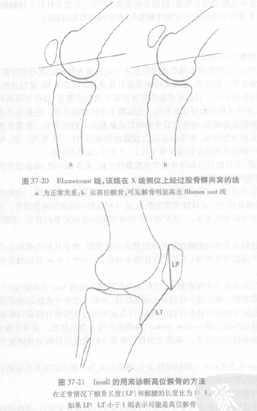 (四)持久性髌骨脱位对先天性持久性髌脱位来说,4岁之前(髌骨于4岁前