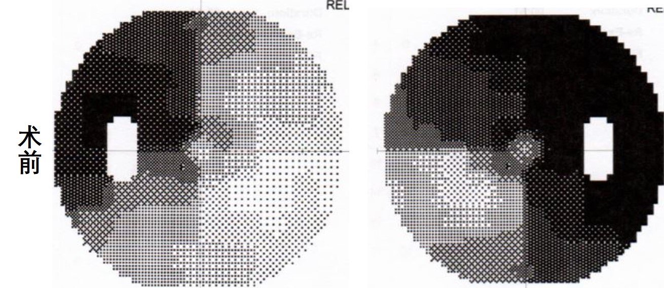 术前视力视野检查示:双颞侧明显偏盲该患者为中年女性,因视物模糊前
