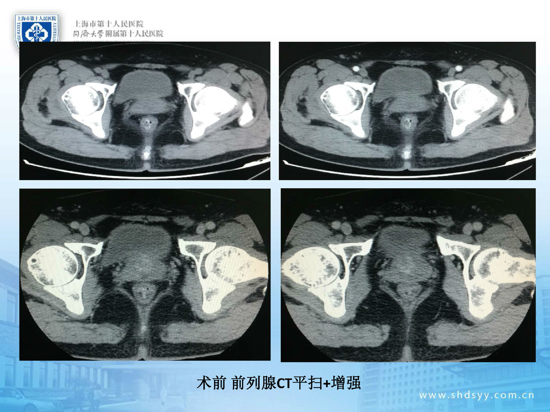 6cm,前列腺不均匀强化(见图前列腺ct平扫 增强).