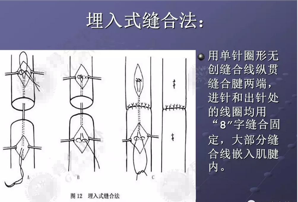 肌腱韧带损伤肌腱缝合的原则和方法汇总