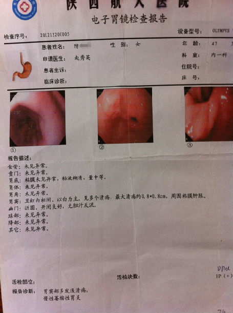 膏方治疗萎缩性胃炎患者的胃镜病理前后对照图片