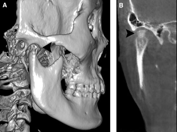 颞下颌关节髁突骨软骨瘤的发生部位有图片