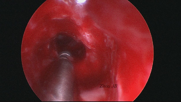 内窥镜鼻窦手术中应重视额窦功能性开放