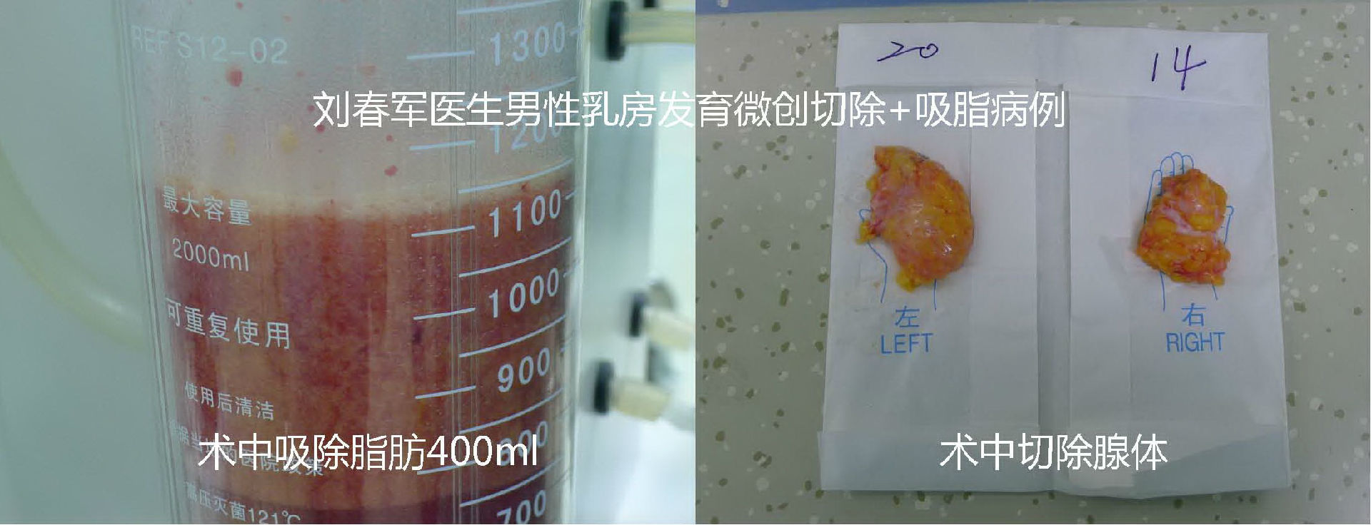 原创男性乳房发育手术问答与护理附多组病例效果
