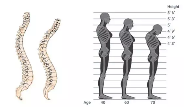 脊柱侧弯会有哪些症状呢