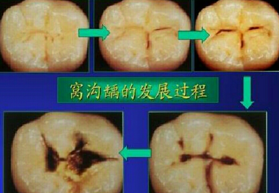 大牙上有黑线是怎么回事?
