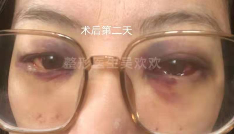 内路眼袋术后血肿的恢复过程
