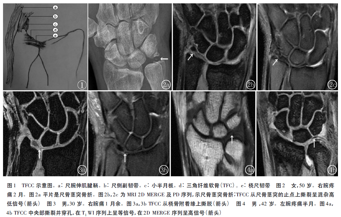 韧带软骨损伤tfcc损伤手腕受伤总是好不了