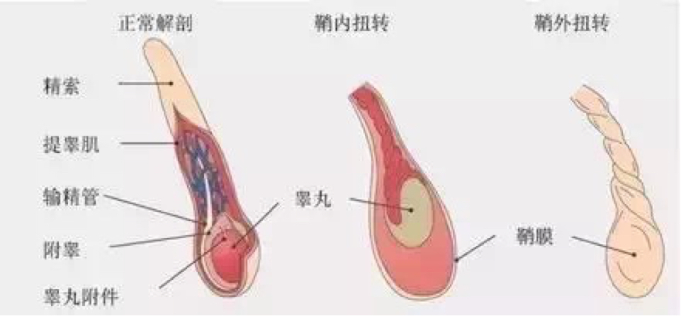 经过检查,原来他的情况是"睾丸附件扭转"还好及时送院才保住他的睾丸