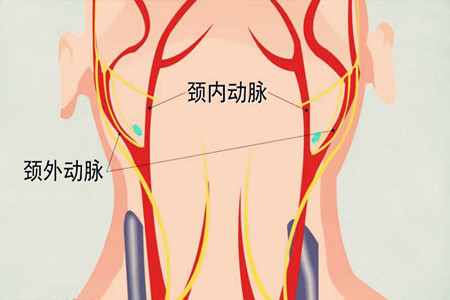 专家为你解说生命之桥颈动脉狭窄